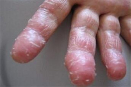 手脱皮是怎么回事 导致手脱皮的四个常见原因