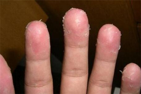 手脱皮是怎么回事 导致手脱皮的四个常见原因